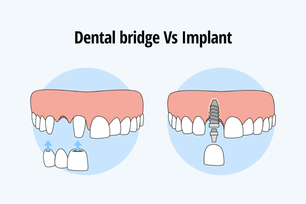 Thooth replacement