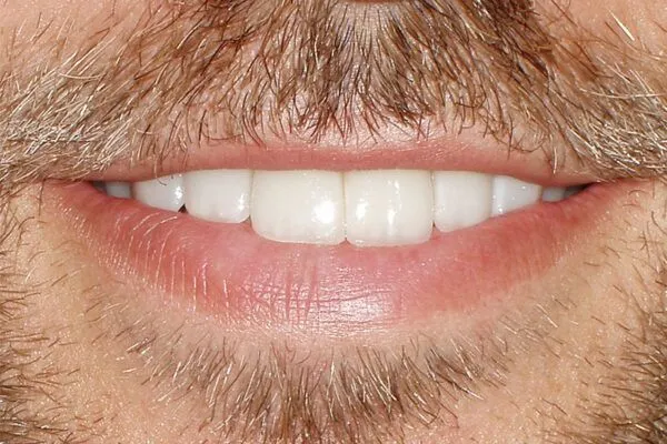 afterfutch1 600x400 1 - Futch Dental