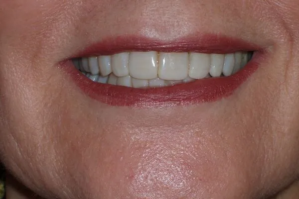 afterfutch2 600x400 1 - Futch Dental