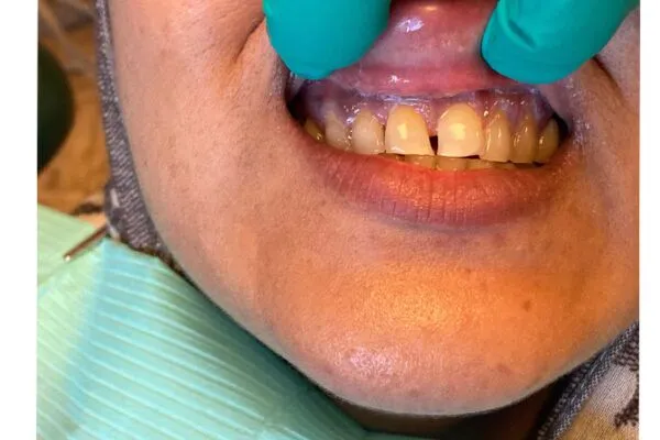 beforefutch 600x400 1 - Futch Dental