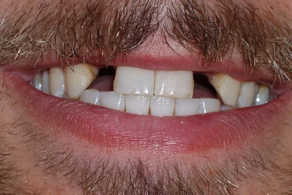 beforefutch1 600x400 1 - Futch Dental