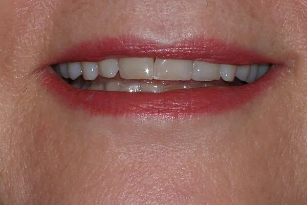 beforefutch2 600x400 1 - Futch Dental