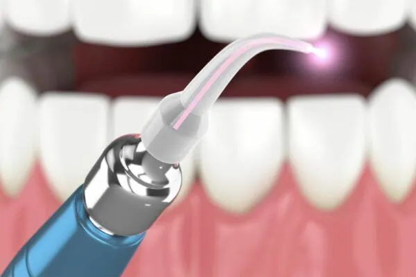 laser dentistry 1 600x400 1 - Futch Dental